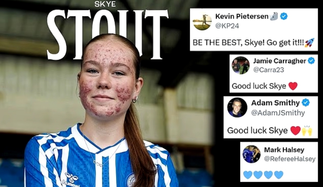 Dukungan untuk Pesepakbola Belia Skye Stout, Kala Jerawat Jadi Sasaran Bullying di Hari Bahagia