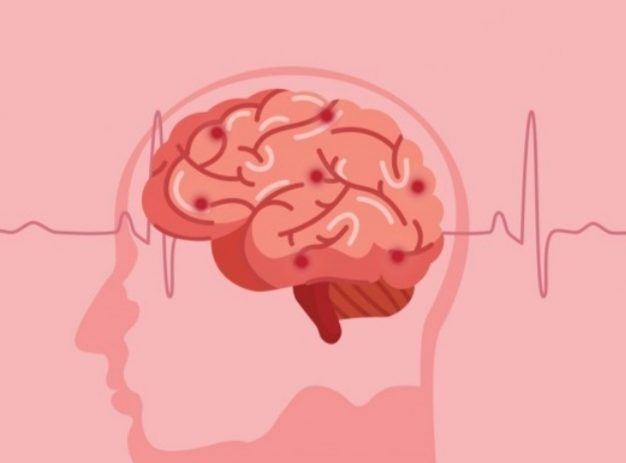 Waspada, Minuman Ini Picu Stroke