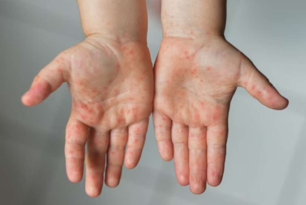 Indonesia Darurat Campak: Kasus Tertinggi Kedua Dunia, Antivaksin Jadi Sorotan