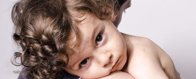 Jangan Asal Izinkan Anak Keluar Rumah Saat Campak, Ini Risiko yang Mengintai